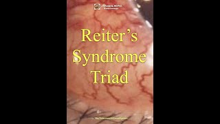 Reiter’s Syndrome Triad.