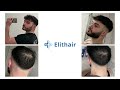 hair transplant before and after month by month results elithair