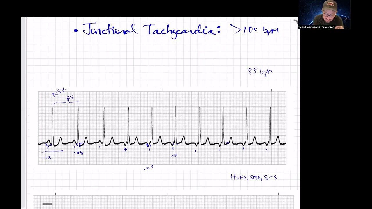 Quick Junctional Rhythms Review- Paramedic Cardiology - YouTube