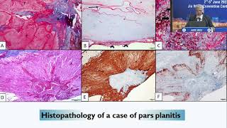 AIOC2022 - IC5 -   Immune mediated uveitis – bench to bedside - Dr Jyotirmoy Biswas