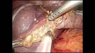 Laparoscopic Anatomical Combined Segment 3 and Segment 4 Liver Resection