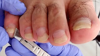 The patient did not dare to cut his nails 3 months after healed from paronychia