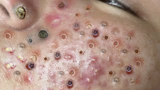 Loan Nguyen Acne Treatment 55x