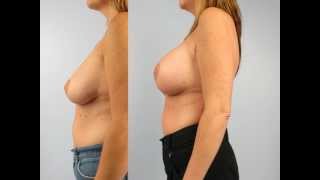Breast Augmentation at Allure Medical Spa | Dr. Charles Mok