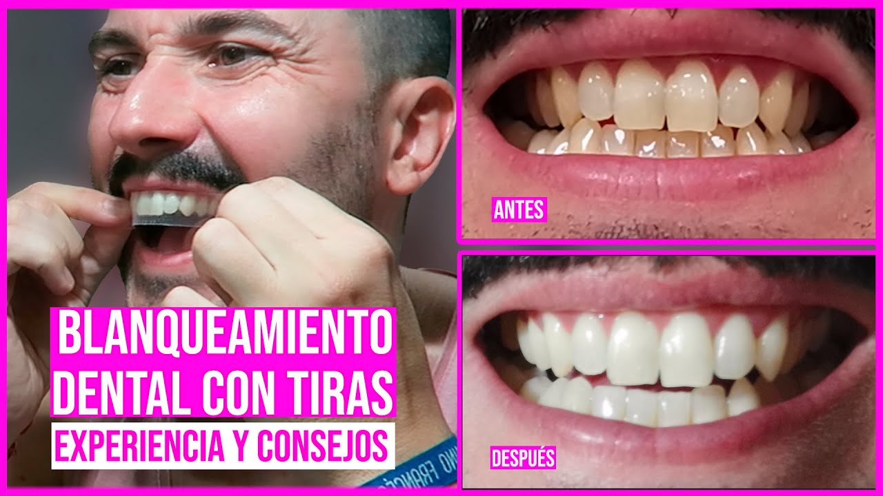 DIENTES Más BLANCOS En 30 Minutos Con TIRAS BLANQUEADORAS - EXPERIENCIA ...