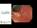 たまプラーザ南口胃腸内科クリニック～大腸ポリープ（大腸腺腫）　日帰り内視鏡治療　ポリペクトミー～