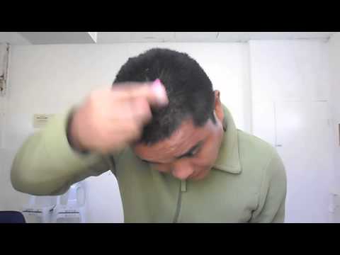 Amazing Result Scalp Dandruff Treatment Using Coconut Oil Amazing Result Scalp Dandruff Treatment Using Coconut Oil