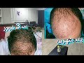 نتيجه زراعه شعر طبيعي بعد 6 شهور من الزراعه