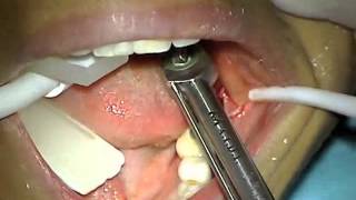 AIDI NanoMicro \u0026 IDI Implant Immediate Placement