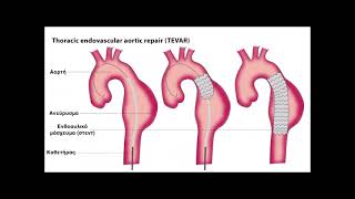 13.Ανευρυσμα Αορτης