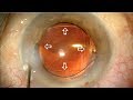 Captura capsular inversa en ojos con disfotopsias.