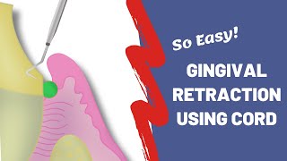 Gingival Retraction using Cords | The Easy Way!