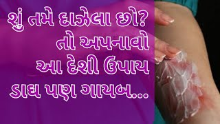 શું તમે દાઝી ગયા છો,તો અપનાવો આ ઘરેલું ઉપાય અને મેળવો હતી તેવી નેતેવી ત્વચા,ડાઘ ને કહો ગુડબાય,DrDave