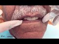 طقم اسنان متحرك د سامي سعيد ..complete denture dr sami saeed