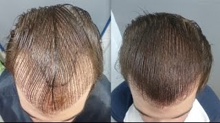 2501 Grafts. FUE Technique. HT Repair. Early regrowth at 5 months. Injertocapilar.com.1813/2016