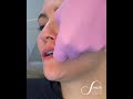 Lip Filler Procedure | Board Certified Facial Plastic Surgeon