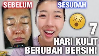 7 HARI CHALLENGE PAKE KRIM KOREA INI DAN HASIL NYA ... COCOK UNTUK KULIT JERAWAT !