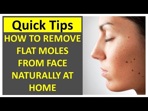 How to Remove Flat Moles from Face Naturally At Home How to Remove Flat Moles from Face Naturally At Home