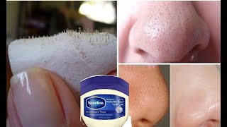 How to remove blackheads using Vaseline from the first use 100% effective