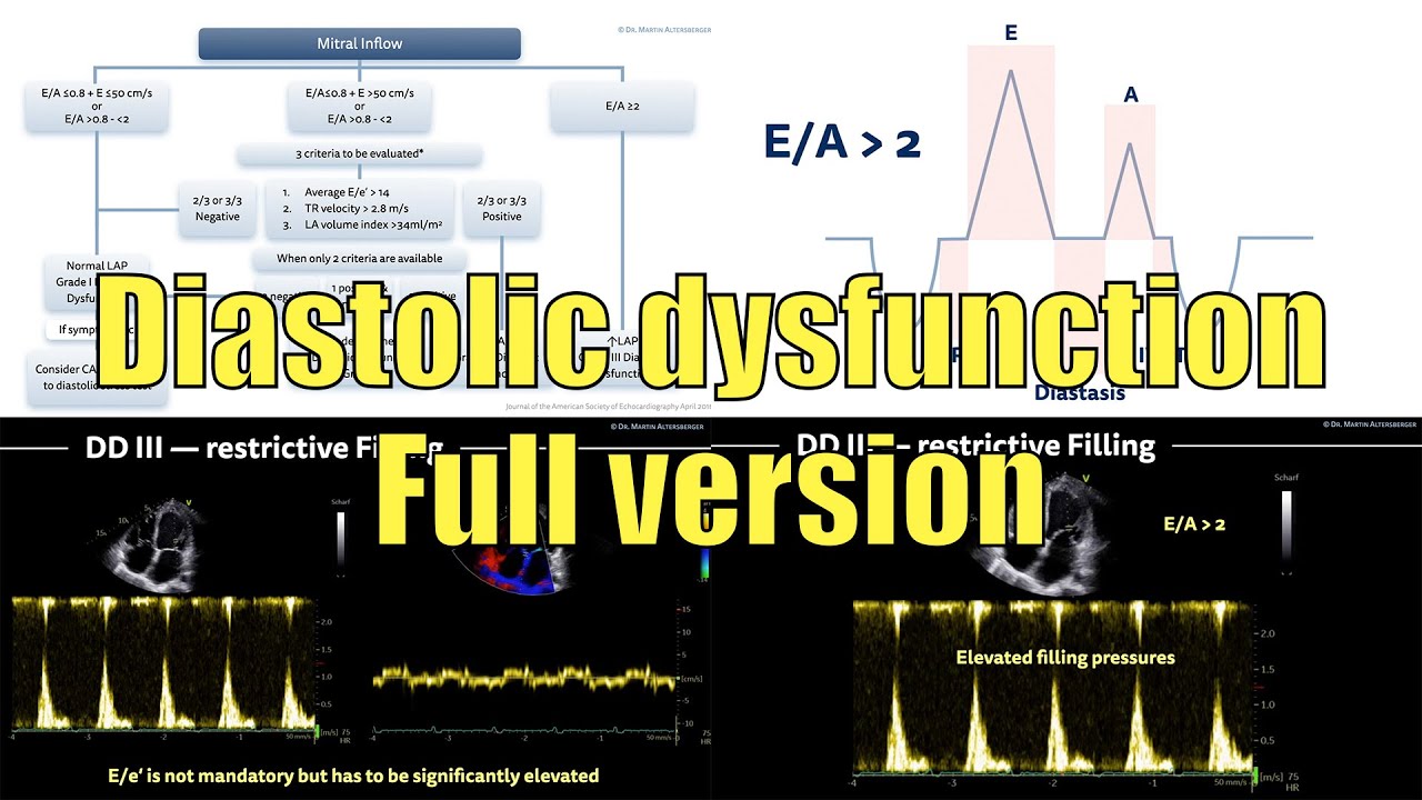 уацechocardiographyуач Diastolic Dysfunction Full Version ёятш Youtube