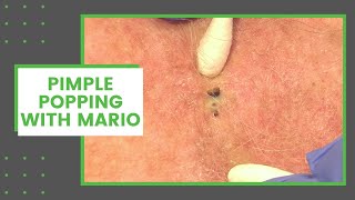 Pimple Popping with Mario | Dr. Derm