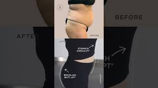 Jen Linton Stomach AirSculpt and Power BBL Fat Transfer