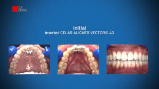 Clinical Case - CA CLEAR ALIGNER