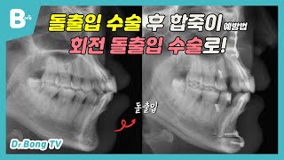 [닥터봉TV_CBK성형외과_최봉균] 돌출입 수술 후 합죽이 예방,  회전 돌출입 수술로 양악수술 효과를![CBK整形外科_チェ·ボンギュン] 突出口手術後の老顔予防、回転突出口手術！