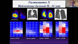 Новые возможности обработки сцинтиграмм легких