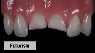 Front Tooth Reconstruction