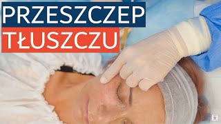 Przeszczep własnej tkanki tłuszczowej w zabiegach na twarz ADIVIVE