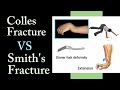 Colle's Fracture VS Smith's Fracture II Timesphysio