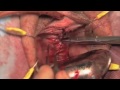 lone star aps retractor anterior repair procedure