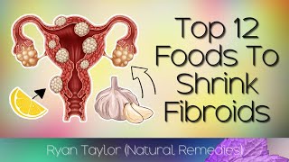 12 Foods That Shrink Fibroids (Naturally)