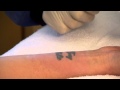 Laser Tattoo Removal