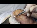 removing extremely massive heel callus bones under pressure foot care callus podiatry part 2