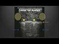 Ultrasound Artifacts