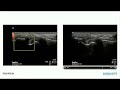 ultrasound evaluation of the medial and lateral knee