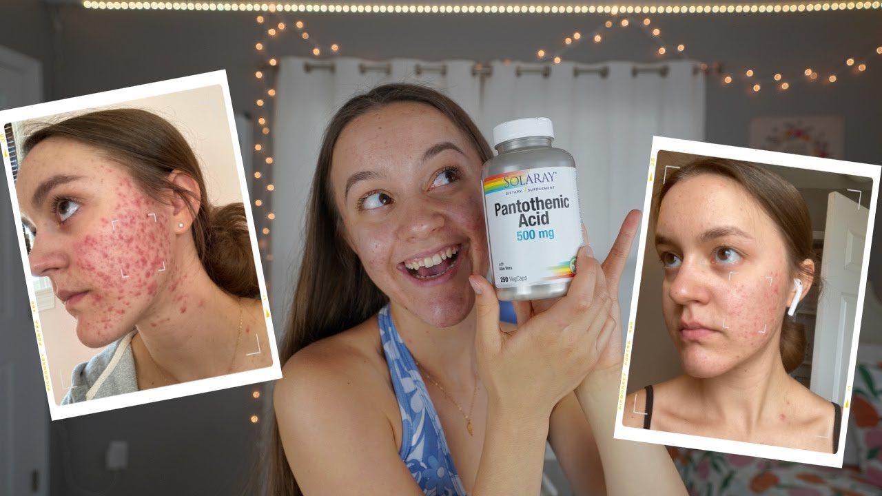 I TOOK PANTOTHENIC ACID FOR 2 MONTHS | Pantothenic Acid (B5) For Acne ...