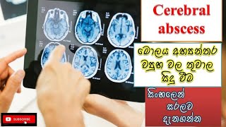 cerebral abscess/මොලය අභ්‍යන්තරයේ තුවාල ඇති වීම/how happens/cause/treatment/sinhala/ how to prevent