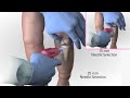 Arrow EZ IO Infant Child Needle Selection and Insertion Technique Animation Video