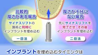 サイナスリフト「匠歯科クリニック」（福岡市）