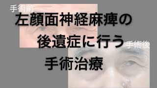 顔面神経麻痺後遺症（ハント症候群）　まぶたの手術後の経過