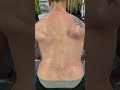 Winged Scapula Progress After Years of Long Thoracic Nerve Damage