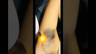 #blackness underarms laser treatment #permanent treatment 100% #laser #skin #glowingskin #shrots