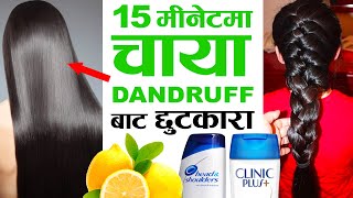 15 मिनेटमै कपालको चाया DANDRUFF बाट पाउनुहोस छुट्कारा | Hair Dandruff Home Remedy in Nepali