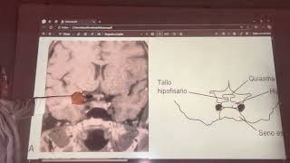 Endocrinología. Clase 12 - Adenomas