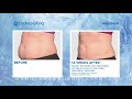 coolsculpting 冷冻减脂｜伦敦｜pulse light clinic