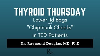 THYROID THURSDAY - How to Remove Chipmunk Cheeks from Thyroid Eye Disease?