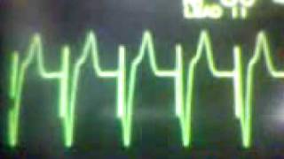 ECG Video: Pacemaker Rhythm